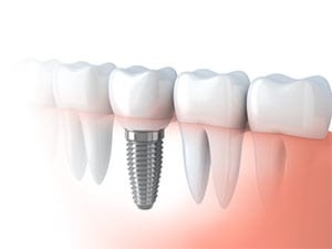 Dental Implant in Vizag